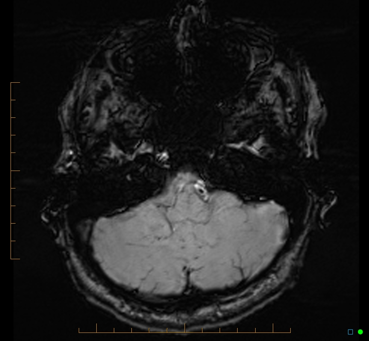 Cerebellar gangliocytoma (Radiopaedia 65377-74422 Axial SWI 11).jpg