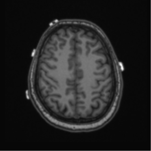 File:Cerebellar hemangioblastomas and pituitary adenoma (Radiopaedia 85490-101176 Axial T1 55).png
