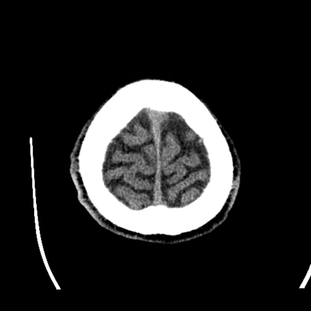 Cerebellar hemorrhage (Radiopaedia 27193-27359 Axial non-contrast 51).jpg