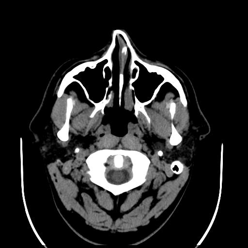 File:Cerebellar infarction (Radiopaedia 16625-16327 Axial non-contrast 2).jpg