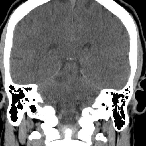 Cerebellar infarction (Radiopaedia 16625-16327 Coronal non-contrast 19).jpg