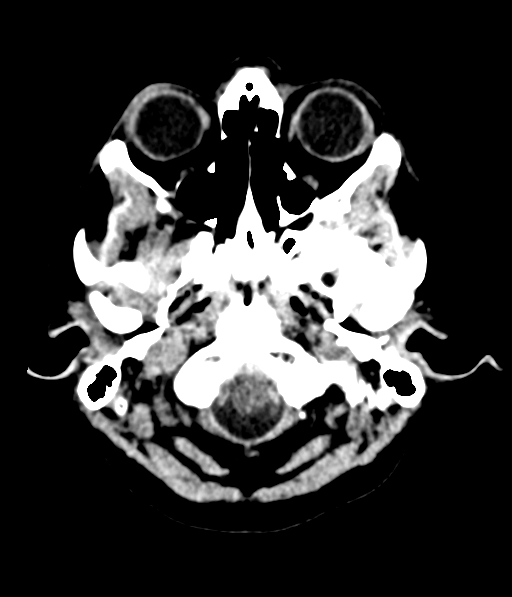 Cerebellar metastases - colorectal adenocarcinoma (Radiopaedia 40947-43652 Axial non-contrast 5).png