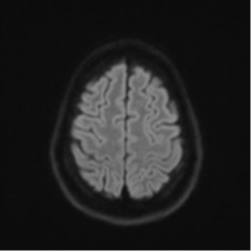 Cerebellar metastasis - adenocarcinoma lung (Radiopaedia 63184-71715 Axial DWI 53).png