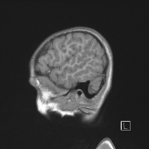 Cerebellar stroke (Radiopaedia 32202-33150 Sagittal T1 C+ 46).png