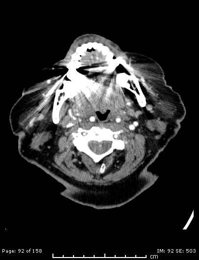 File:Cerebellar strokes due to intracranial giant cell arteritis (Radiopaedia 68799-78510 CT angiogram 92).jpg