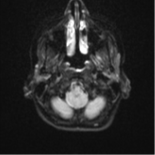 Cerebellar tuberculomas (Radiopaedia 46939-51472 Axial DWI 3).png