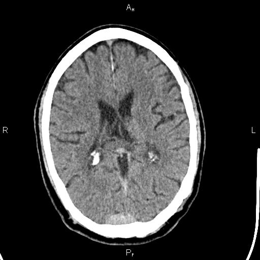 Cerebellopontine angle arachnoid cyst (Radiopaedia 85149-100704 Axial With contrast 28).jpg