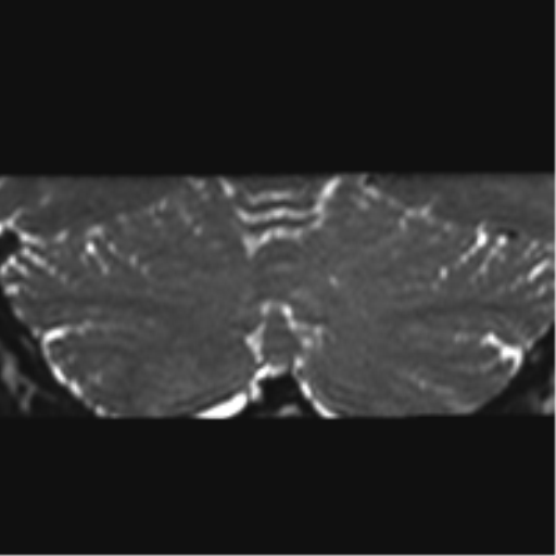 File:Cerebellopontine angle meningioma (Radiopaedia 48434-53348 Coronal T2 9).png