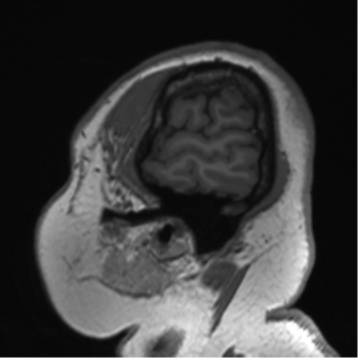Cerebellopontine angle meningioma (Radiopaedia 48434-53348 Sagittal T1 14).png