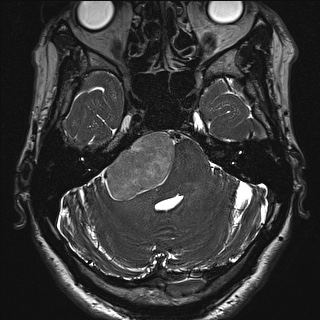 Cerebellopontine angle meningioma (Radiopaedia 72983-83680 Axial FIESTA 35).jpg