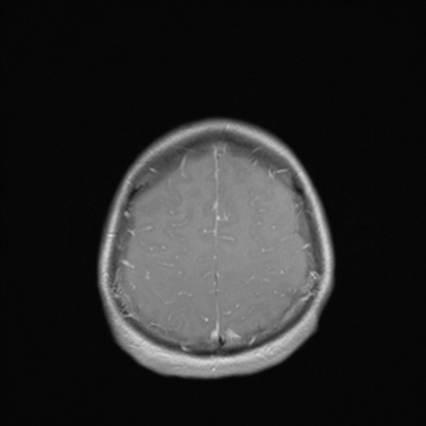 Cerebral abscess (Radiopaedia 24212-24478 Axial T1 C+ 49).jpg