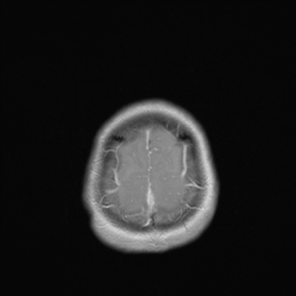 Cerebral abscess (Radiopaedia 24212-24478 Axial T1 C+ 53).jpg