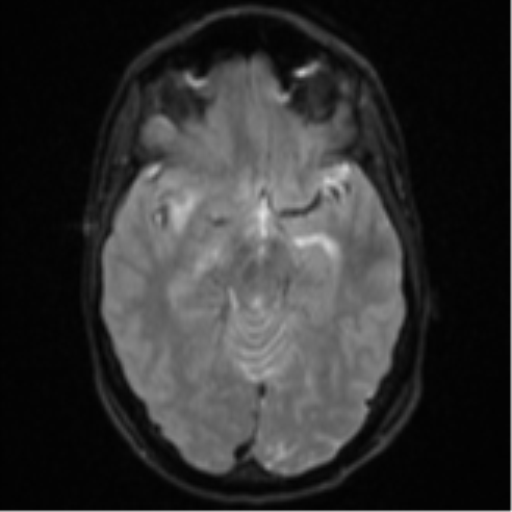 File:Cerebral abscess (Radiopaedia 60342-68009 Axial DWI 14).png