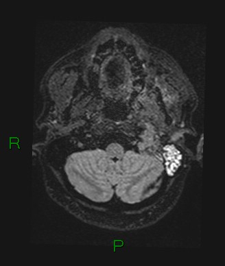 File:Cerebral abscess and subdural empyema (Radiopaedia 84436-99779 Axial FLAIR 73).jpg