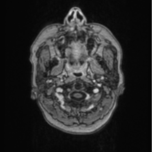 Cerebral abscess from pulmonary arteriovenous malformation (Radiopaedia 86275-102291 Axial T1 C+ 1).png