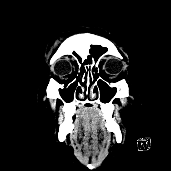 File:Cerebral abscess with ventriculitis (Radiopaedia 78965-91876 B 6).jpg