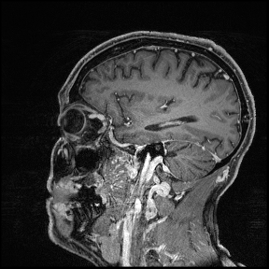 Cerebral abscess with ventriculitis (Radiopaedia 78965-91878 Sagittal T1 C+ 128).jpg