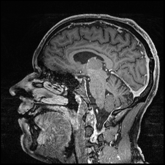 Cerebral abscess with ventriculitis (Radiopaedia 78965-91878 Sagittal T1 C+ 85).jpg