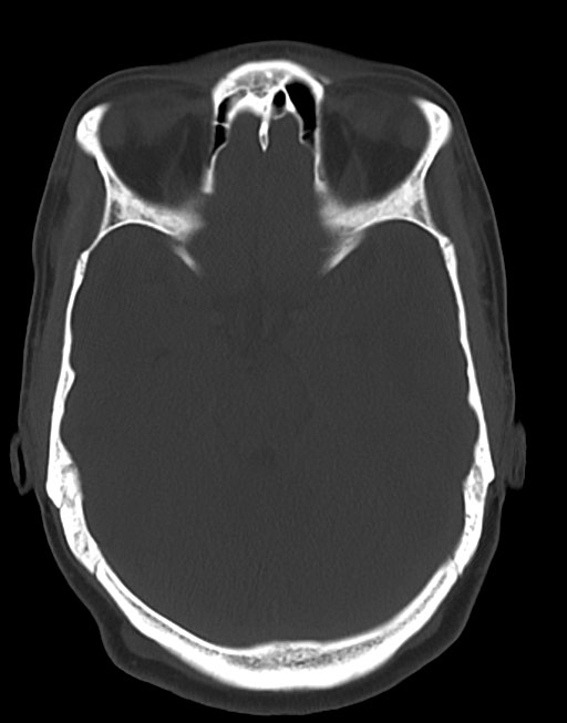 Cerebral abscesses (Radiopaedia 70458-80568 Axial bone window 24).jpg