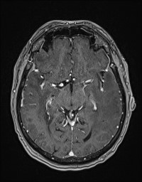 Cerebral amyloid angiopathy-related inflammation (Radiopaedia 58270-65377 Axial T1 C+ fat sat 63).jpg
