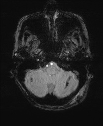 Cerebral amyloid angiopathy-related inflammation (Radiopaedia 74836-85849 Axial SWI 12).jpg