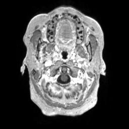 Cerebral amyloid angiopathy (Radiopaedia 29129-29518 Axial T1 C+ 13).jpg