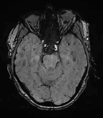 File:Cerebral amyloid angiopathy (Radiopaedia 46082-50433 Axial SWI 28).png