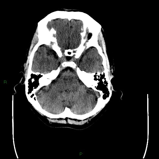Cerebral amyloid angiopathy (Radiopaedia 77506-89665 Axial non-contrast 26).jpg