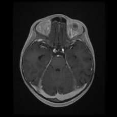 File:Cerebral and spinal tuberculosis (Radiopaedia 90489-107837 Axial T1 C+ 77).jpg