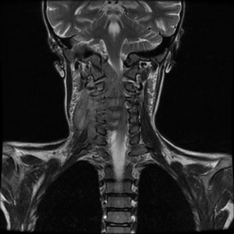 File:Cerebral and spinal tuberculosis (Radiopaedia 90489-107838 Coronal 8).jpg