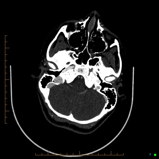 Cerebral arteriovenous malformation (AVM) (Radiopaedia 78162-90706 Axial CTA 71).jpg