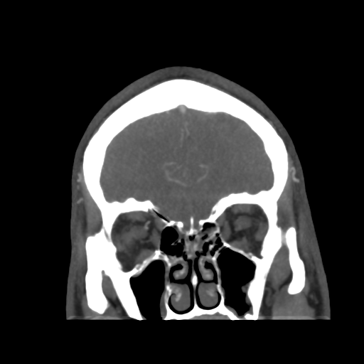 Cerebral arteriovenous malformation (Radiopaedia 39259-41505 E 13).png