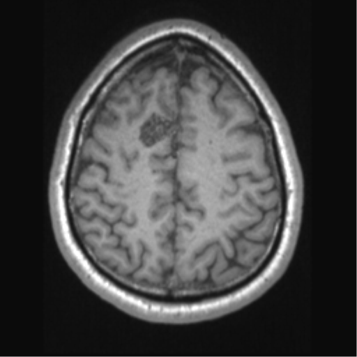 Cerebral arteriovenous malformation (Radiopaedia 39259-41506 Axial T1 59).png