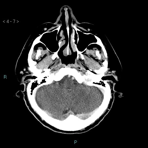 File:Cerebral arteriovenous malformation (Radiopaedia 40528-43125 Axial C+ delayed 7).jpg