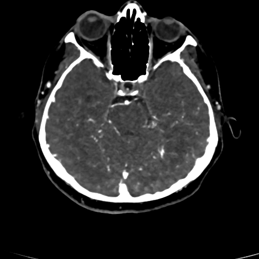 Cerebral arteriovenous malformation (Radiopaedia 73830-84645 Axial C+ delayed 62).jpg