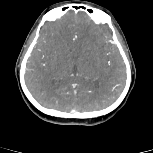 Cerebral arteriovenous malformation (Radiopaedia 73830-84645 B 50).jpg