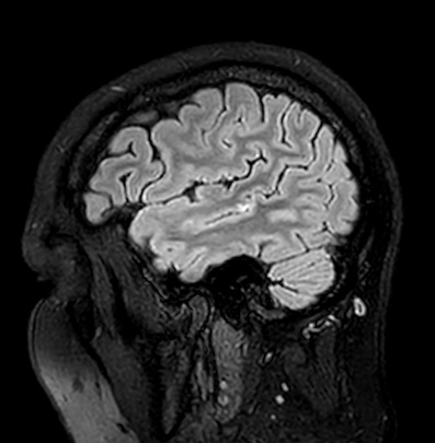 Cerebral arteriovenous malformation (Radiopaedia 74411-85746 Sagittal FLAIR 16).jpg