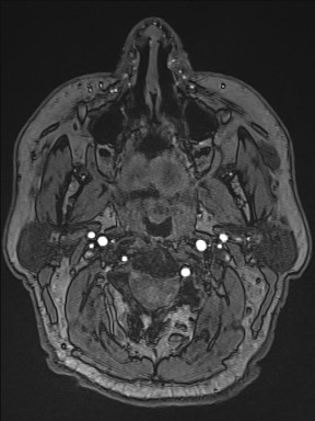 File:Cerebral arteriovenous malformation (Radiopaedia 84015-99245 Axial TOF 2).jpg