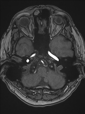 Cerebral arteriovenous malformation (Radiopaedia 84015-99245 Axial TOF 68).jpg
