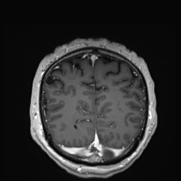 Cerebral arteriovenous malformation (Radiopaedia 84015-99245 Coronal T1 C+ 135).jpg