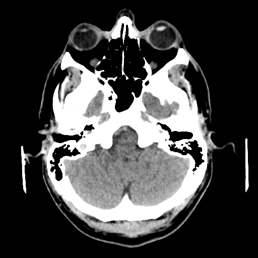 Cerebral arteriovenous malformation (Spetzler-Martin grade 2) (Radiopaedia 41262-44076 Axial non-contrast 13).png