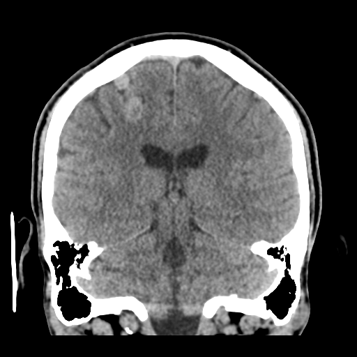 Cerebral arteriovenous malformation (Spetzler-Martin grade 2) (Radiopaedia 41262-44076 Coronal non-contrast 39).png