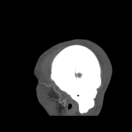 Cerebral arteriovenous malformation (Spetzler-Martin grade 2) (Radiopaedia 41262-44076 G 51).png