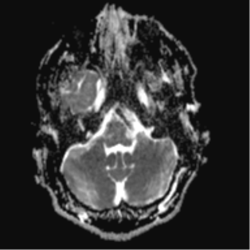 File:Cerebral arteriovenous malformation - huge (Radiopaedia 35734-37272 Axial ADC 5).png