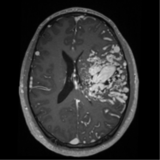 File:Cerebral arteriovenous malformation - huge (Radiopaedia 35734-37272 Axial T1 C+ 43).png