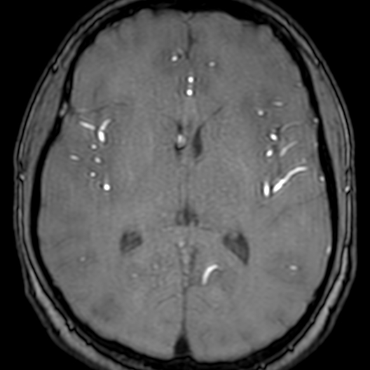 Cerebral arteriovenous malformation at posterior body of corpus callosum (Radiopaedia 74111-84925 Axial MRA 116).jpg