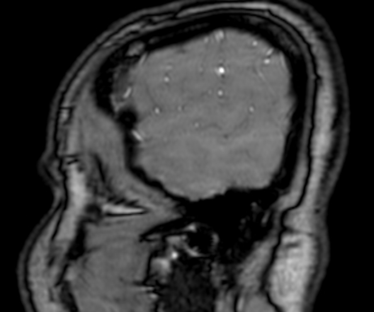 File:Cerebral arteriovenous malformation at posterior body of corpus callosum (Radiopaedia 74111-84925 J 11).jpg