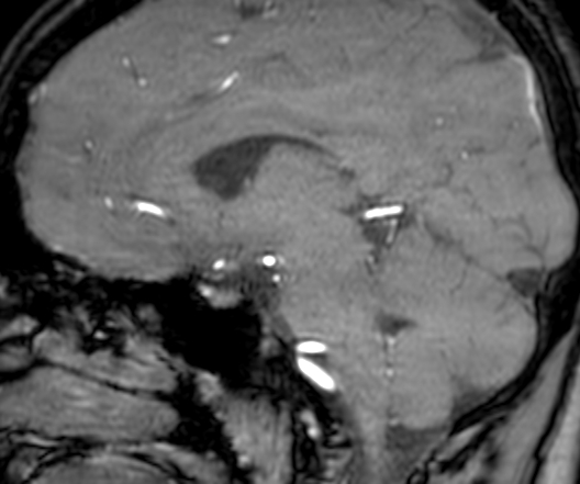 File:Cerebral arteriovenous malformation at posterior body of corpus callosum (Radiopaedia 74111-84925 J 213).jpg