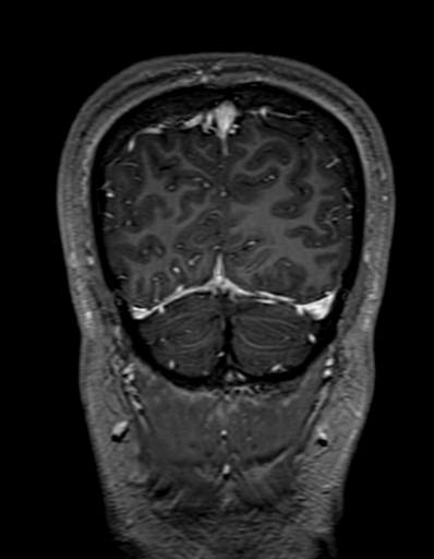 Cerebral arteriovenous malformation at posterior body of corpus callosum (Radiopaedia 74111-84925 K 328).jpg