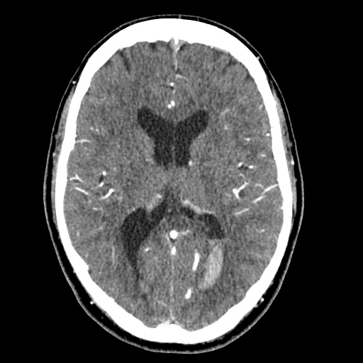 Cerebral arteriovenous malformation with lobar hemorrhage (Radiopaedia 35598-57216 A 34).jpg